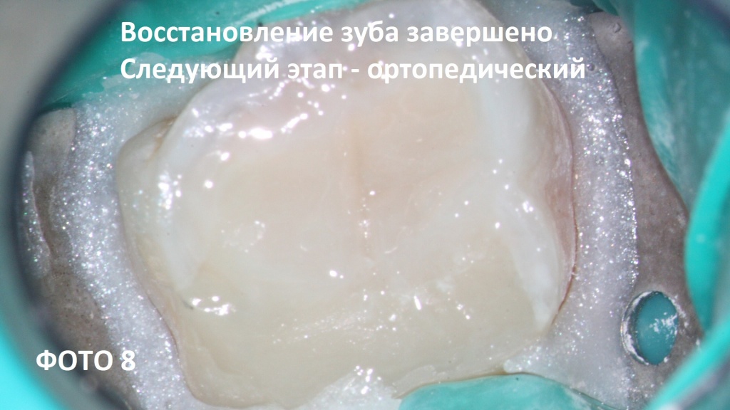 Восстановление зуба под ортопедическую конструкцию коронку